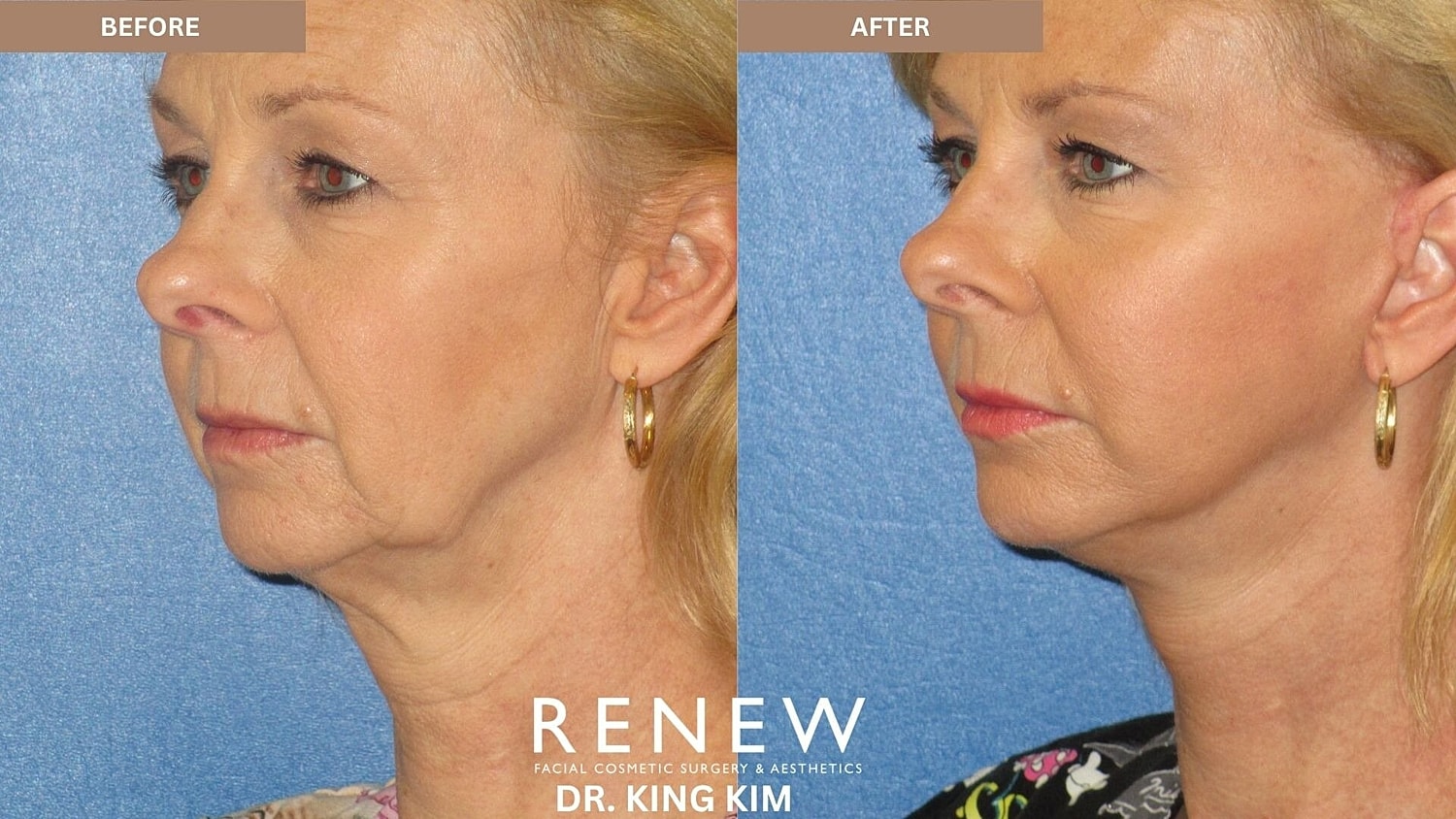 Mini Deep Plane Facelift Before & After