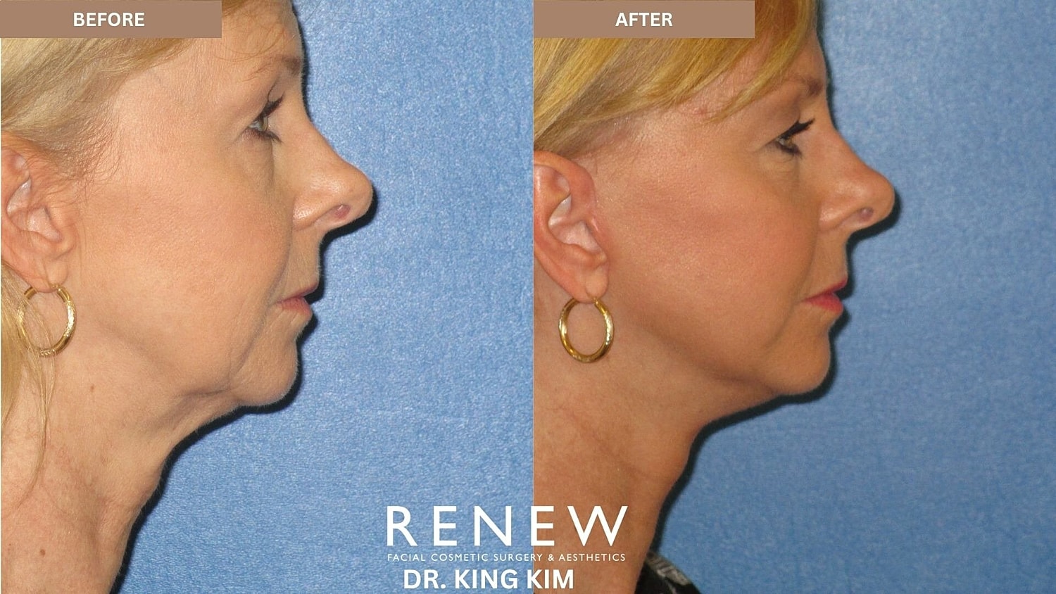 Mini Deep Plane Facelift Before & After