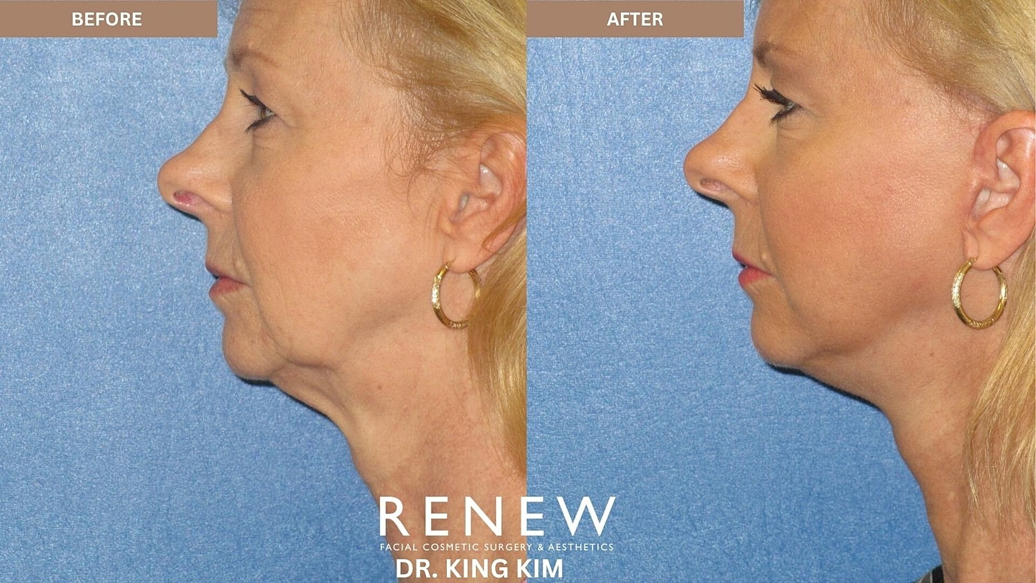 Mini Deep Plane Facelift Before & After