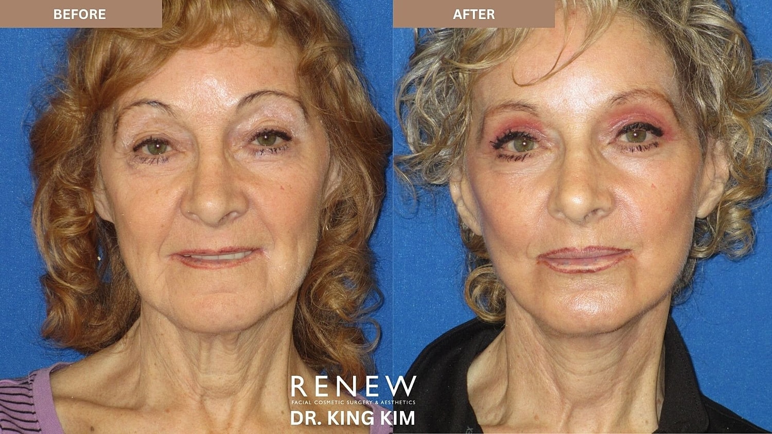 Mini Deep Plane Facelift Before & After