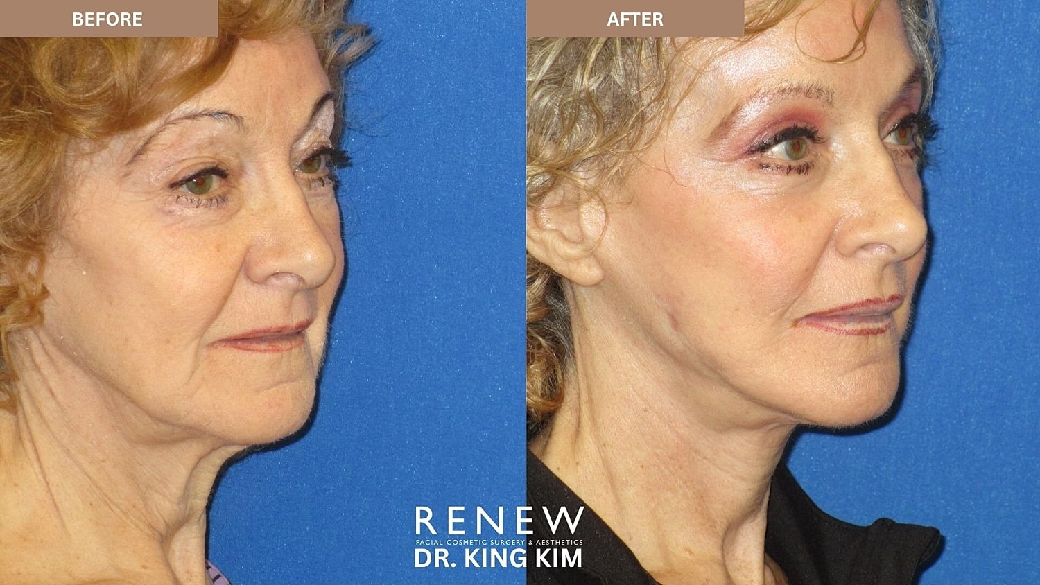 Mini Deep Plane Facelift Before & After