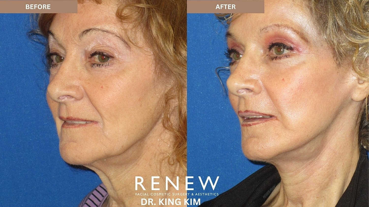 Mini Deep Plane Facelift Before & After