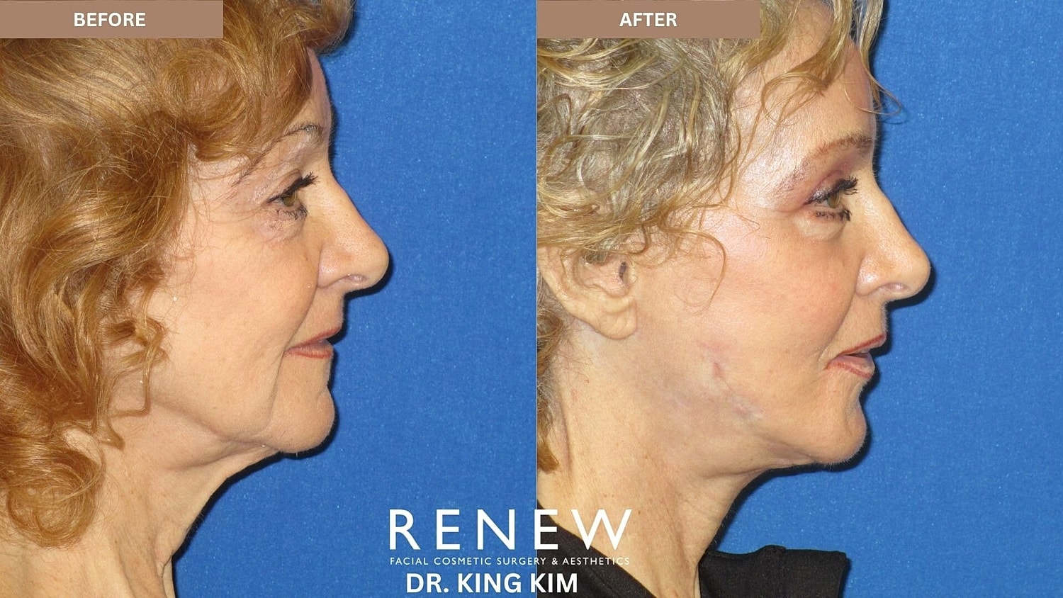 Mini Deep Plane Facelift Before & After