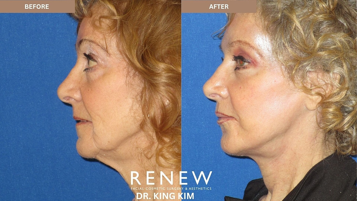 Mini Deep Plane Facelift Before & After