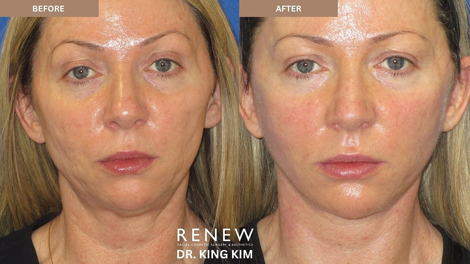 Mini Deep Plane Facelift Before & After