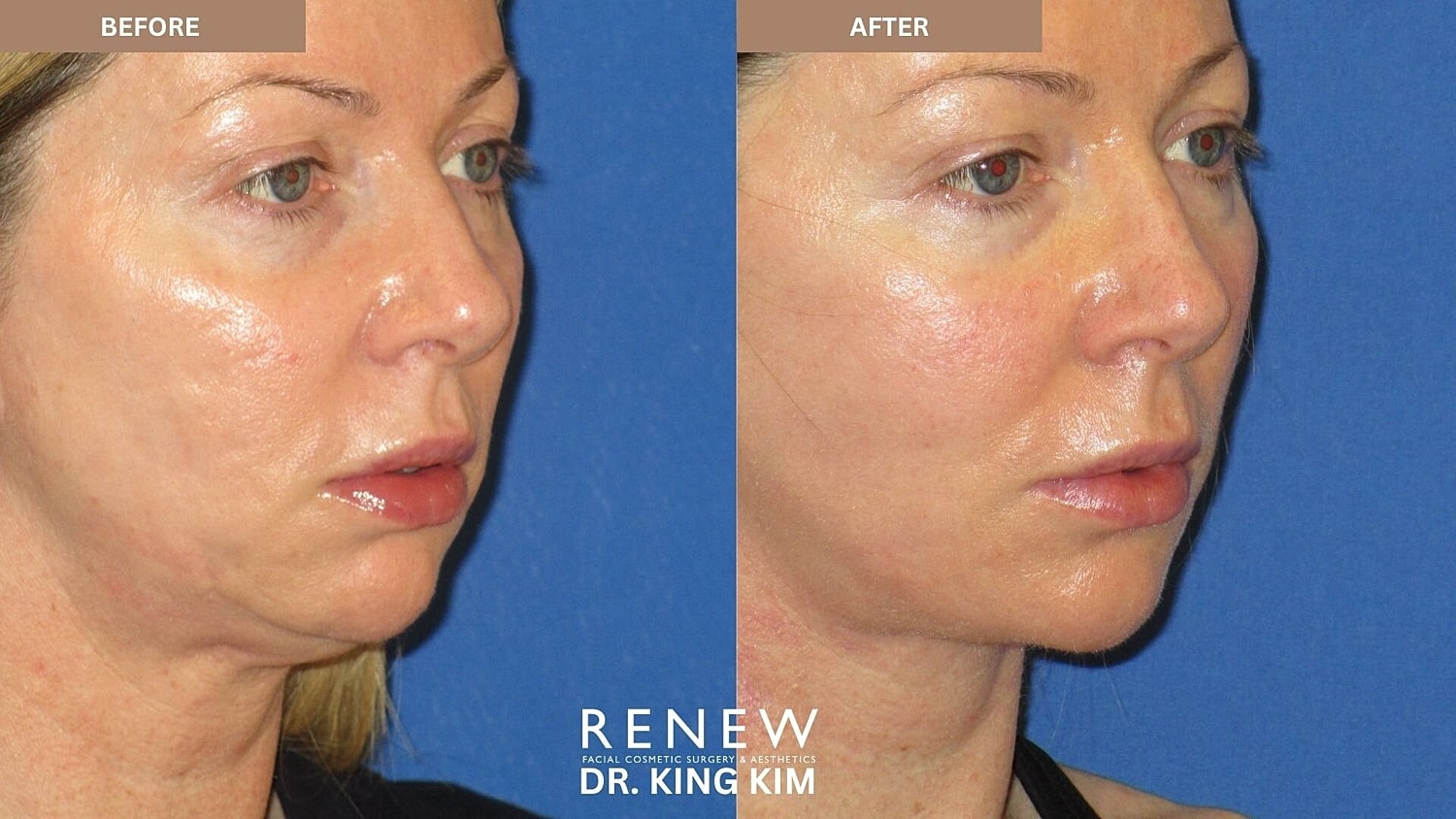 Mini Deep Plane Facelift Before & After