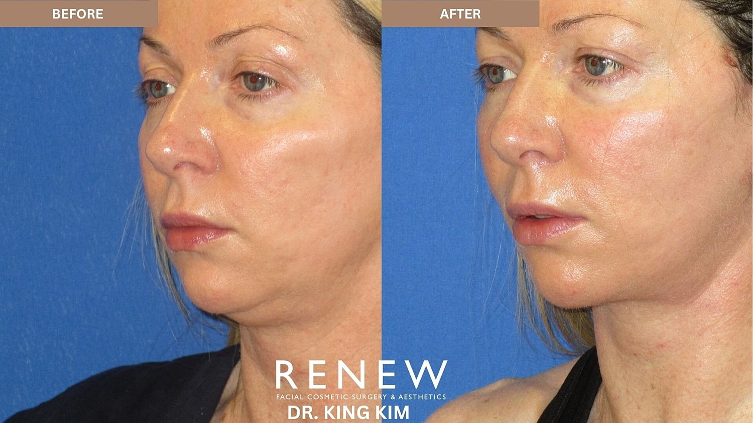 Mini Deep Plane Facelift Before & After