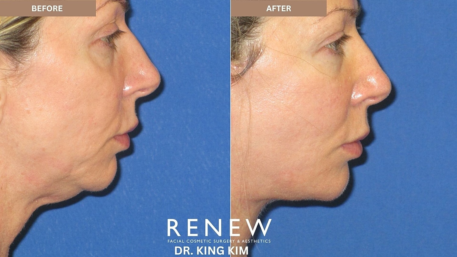 Mini Deep Plane Facelift Before & After