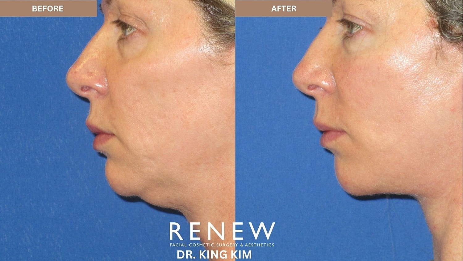 Mini Deep Plane Facelift Before & After