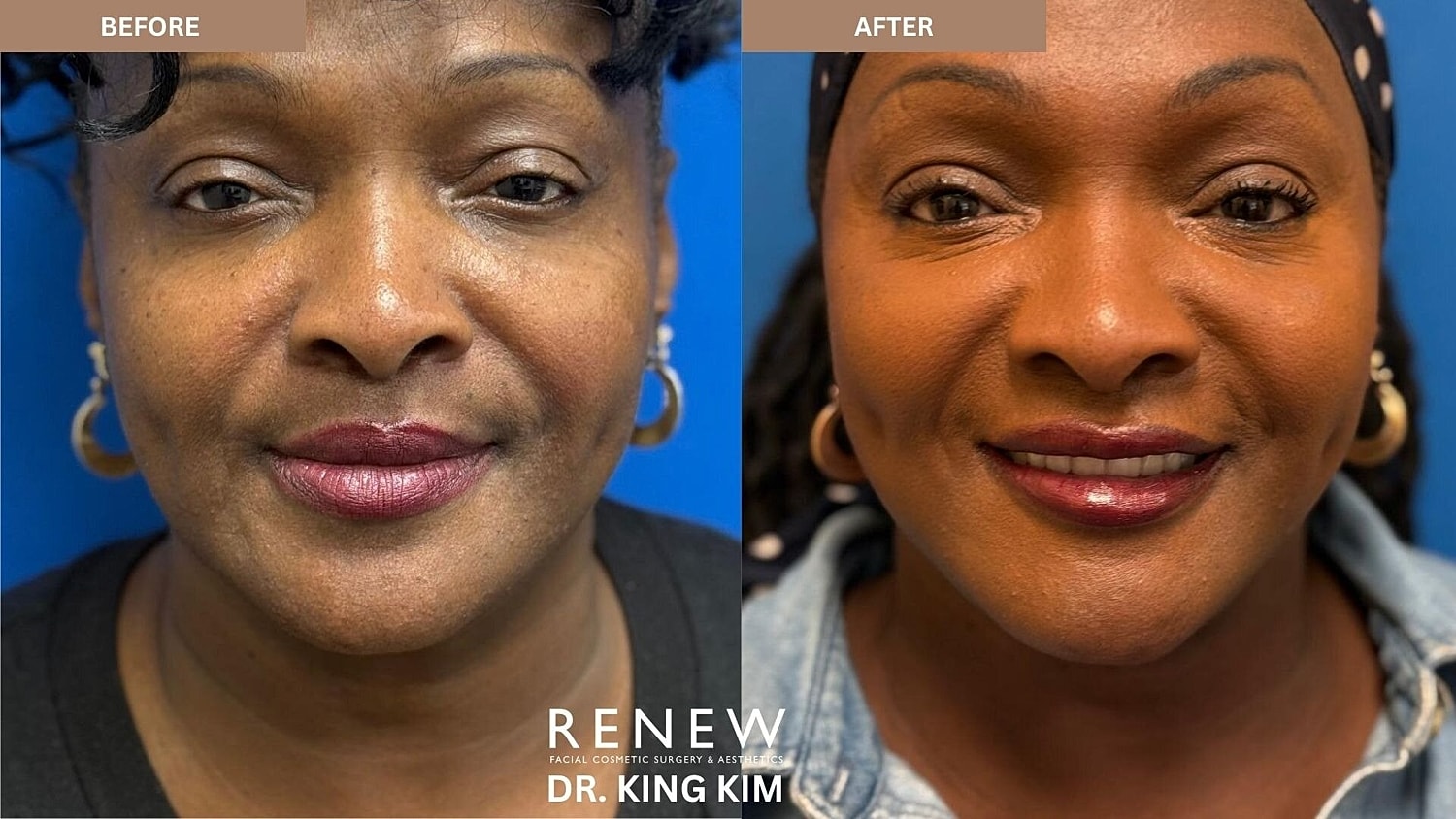 Mini Deep Plane Facelift Before & After
