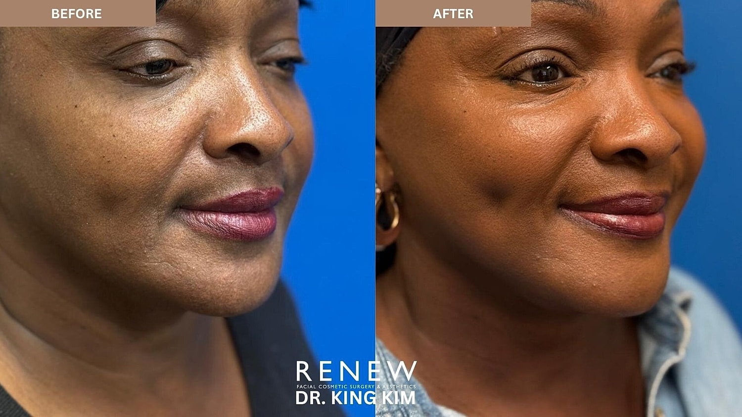 Mini Deep Plane Facelift Before & After