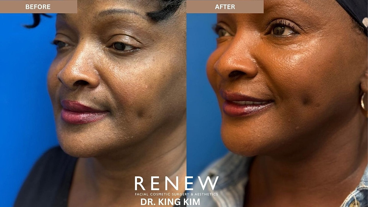 Mini Deep Plane Facelift Before & After