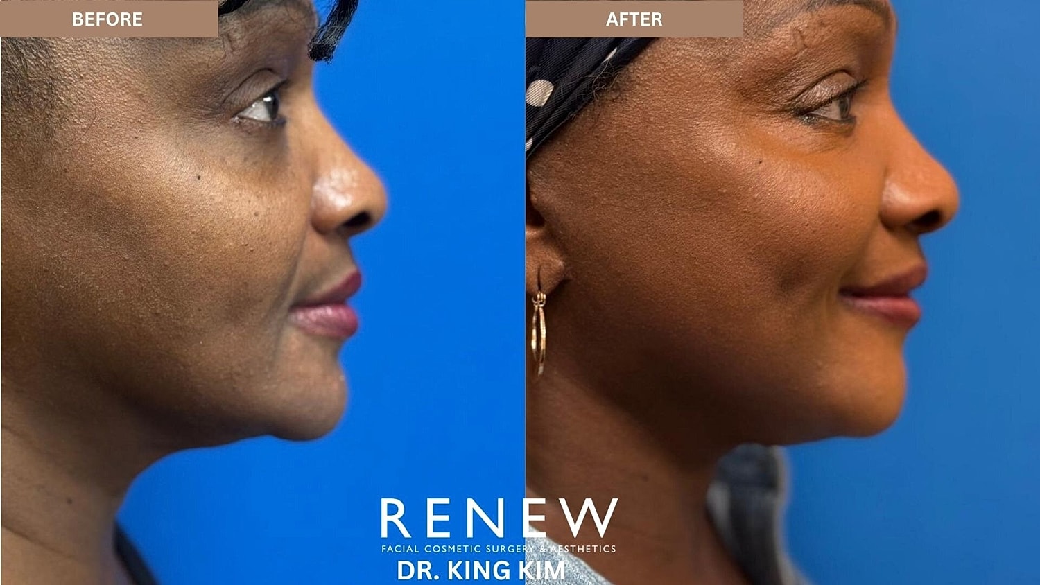 Mini Deep Plane Facelift Before & After