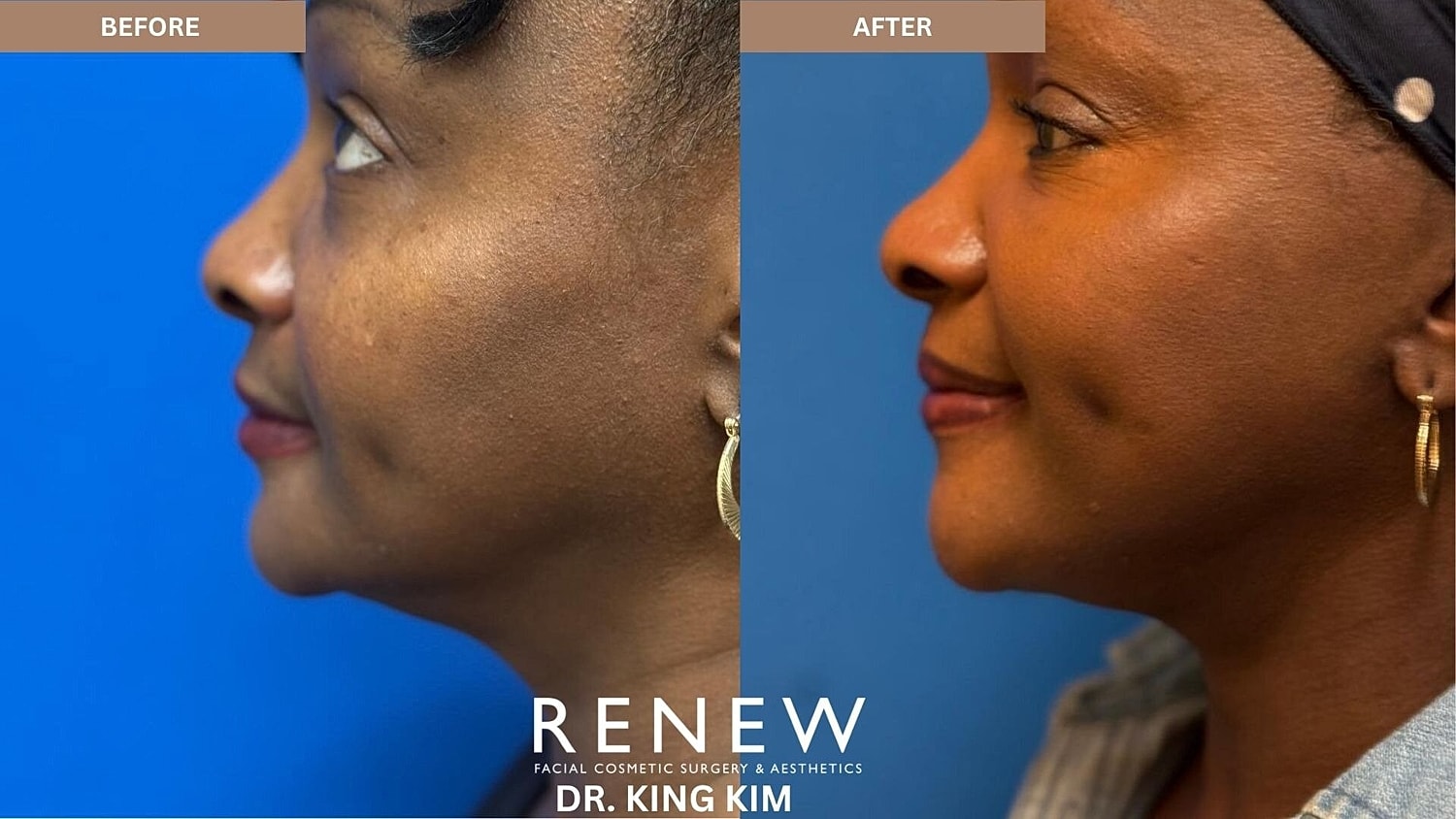 Mini Deep Plane Facelift Before & After