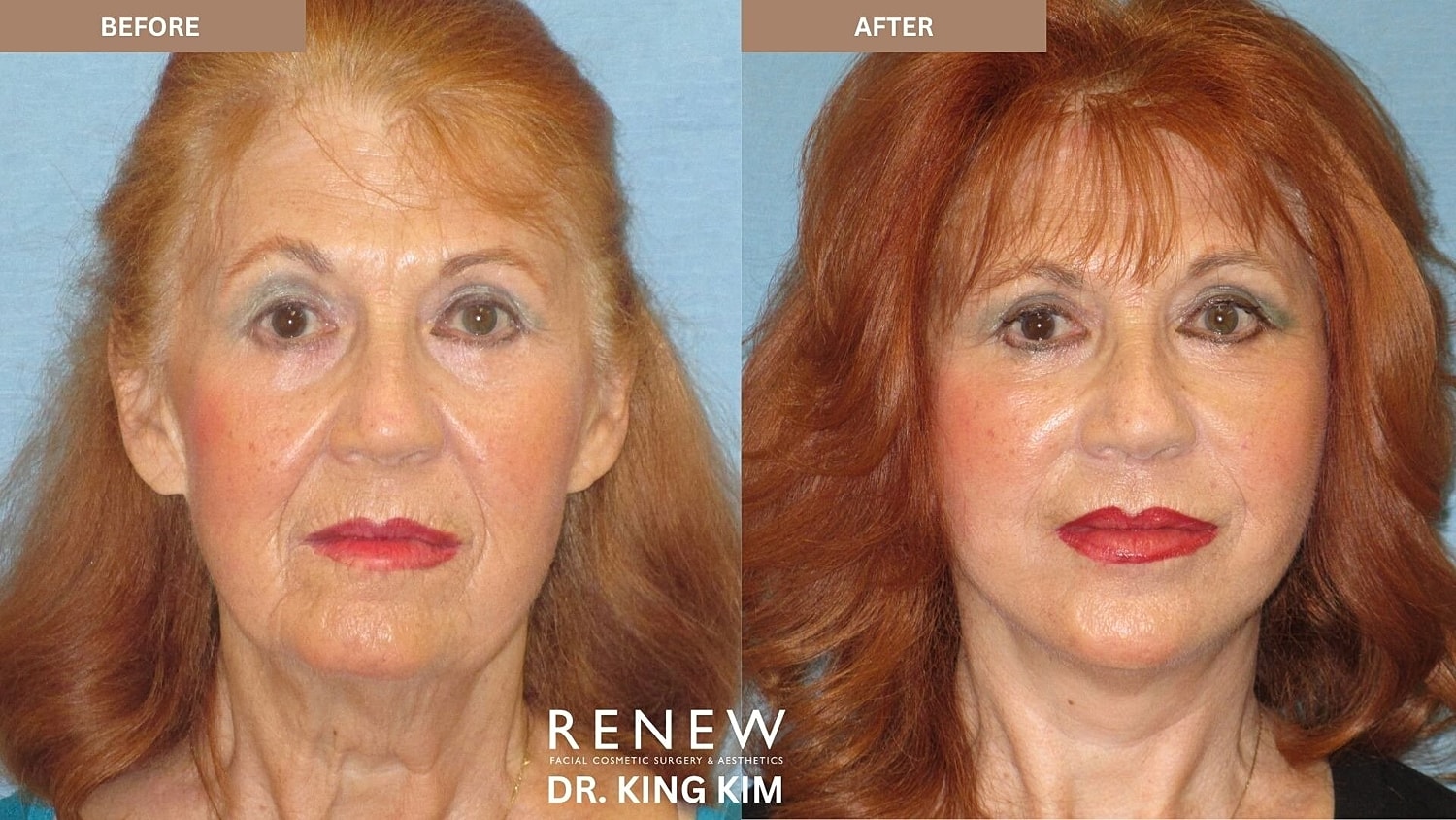 Mini Deep Plane Facelift Before & After