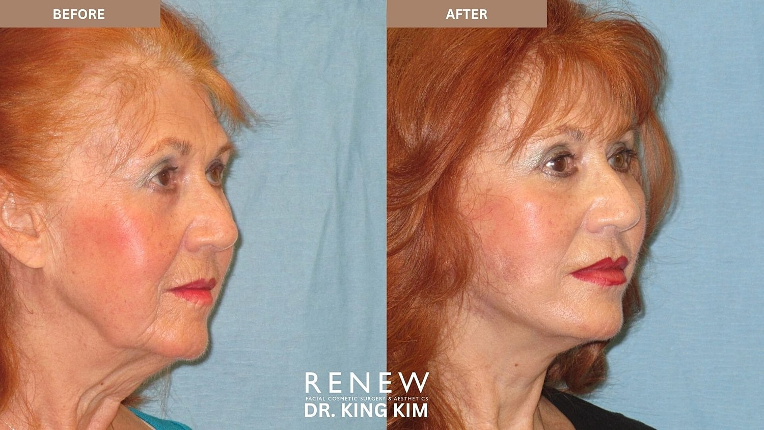 Mini Deep Plane Facelift Before & After