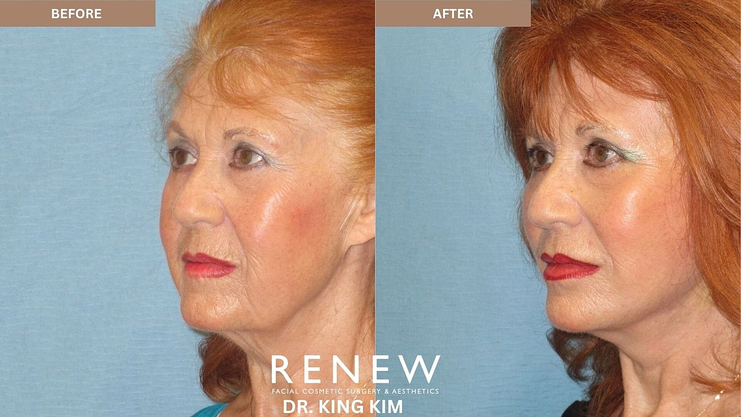 Mini Deep Plane Facelift Before & After