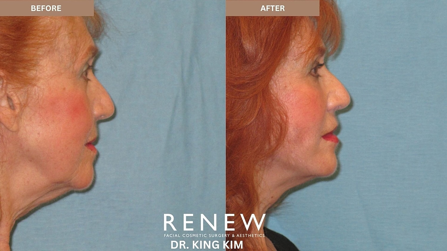 Mini Deep Plane Facelift Before & After