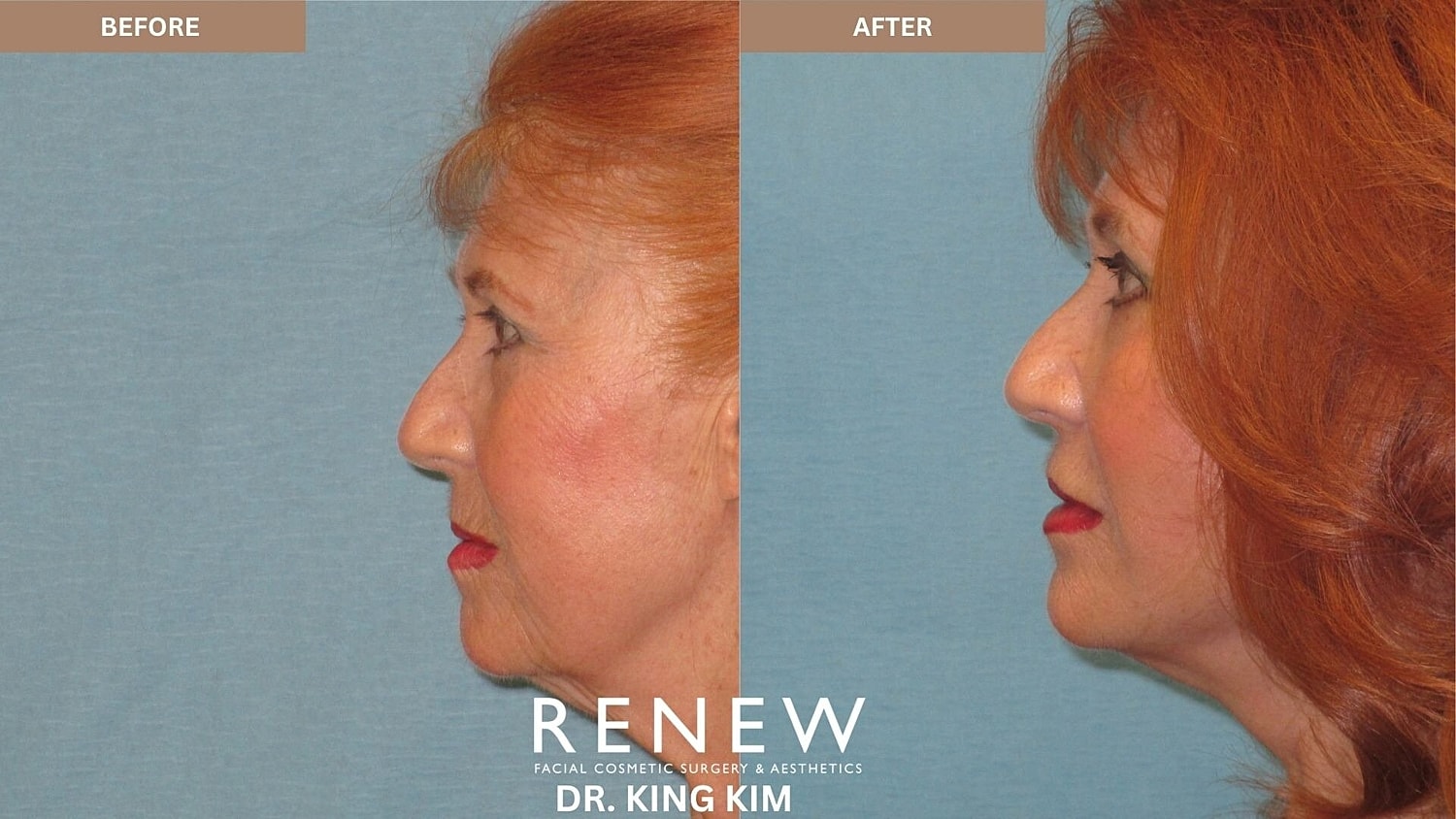 Mini Deep Plane Facelift Before & After