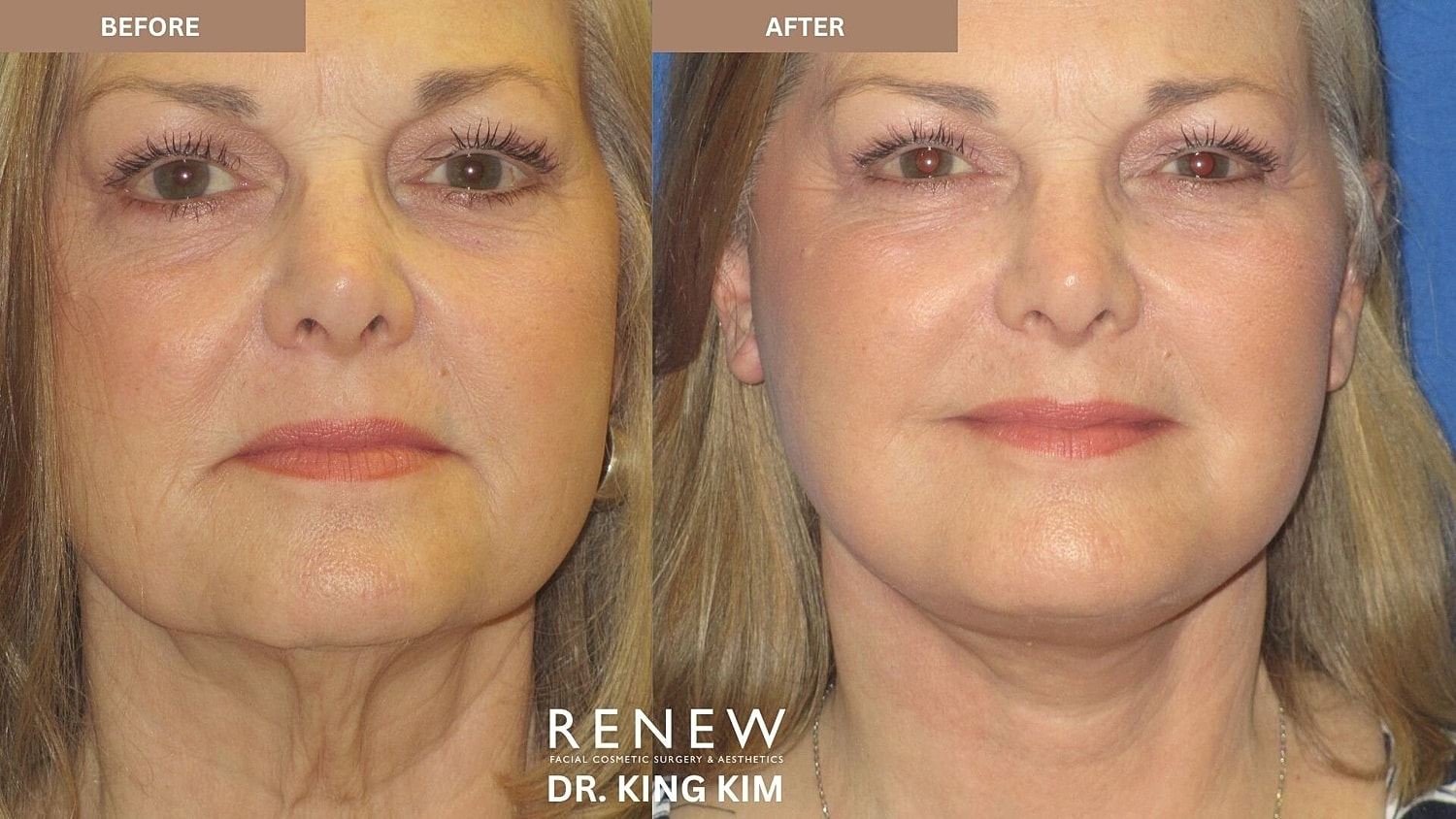 Mini Deep Plane Facelift Before & After