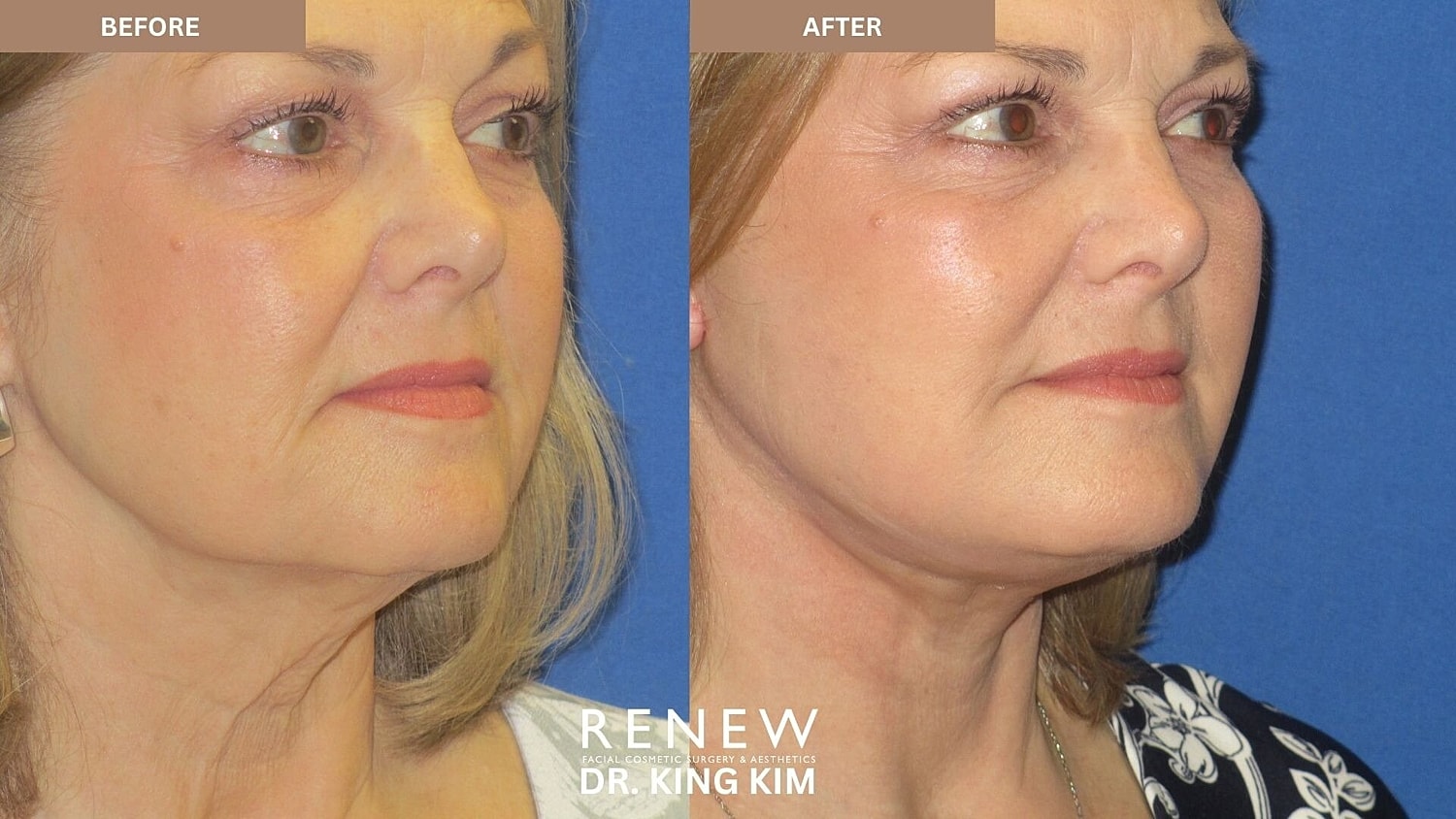 Mini Deep Plane Facelift Before & After