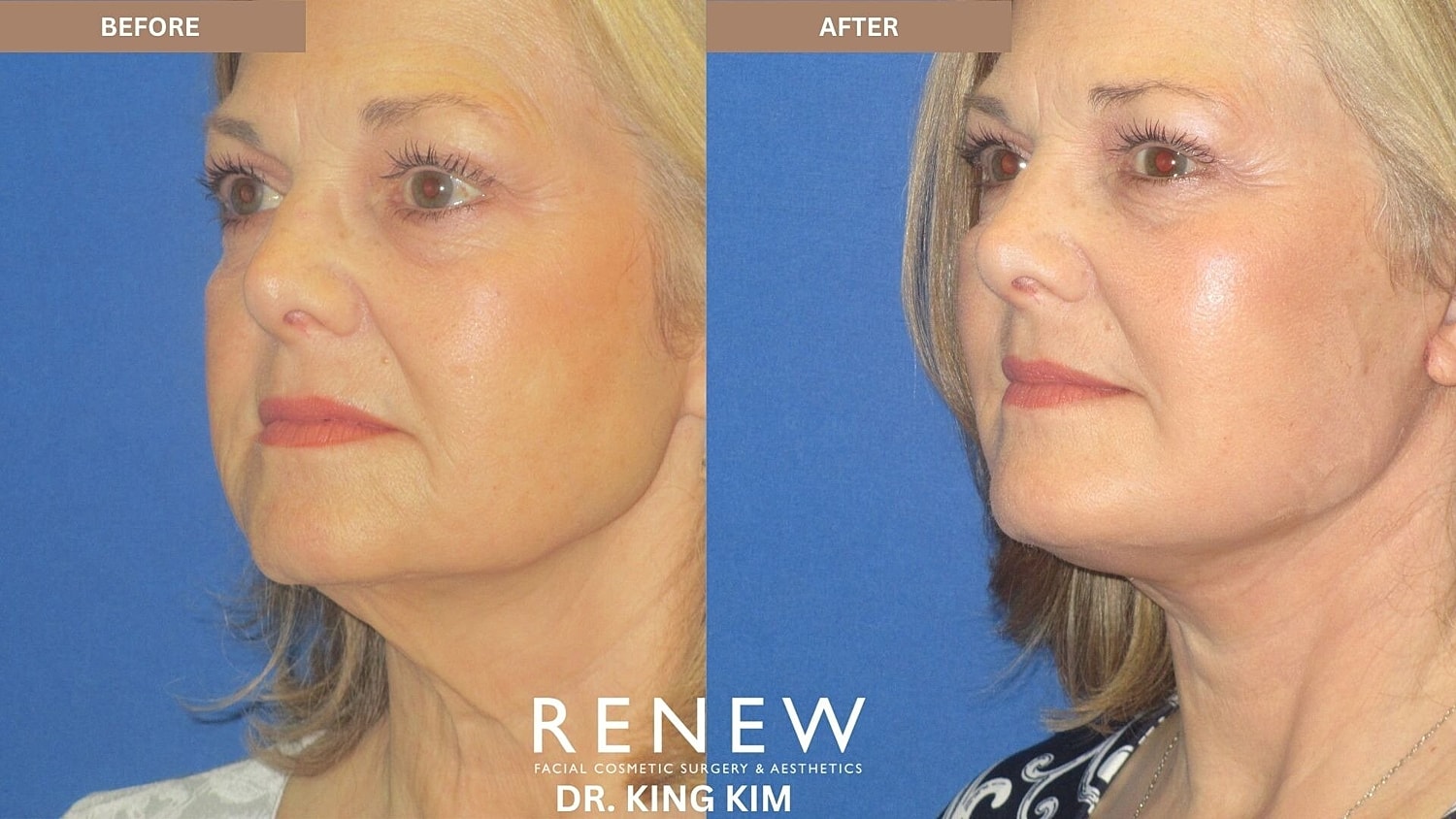 Mini Deep Plane Facelift Before & After