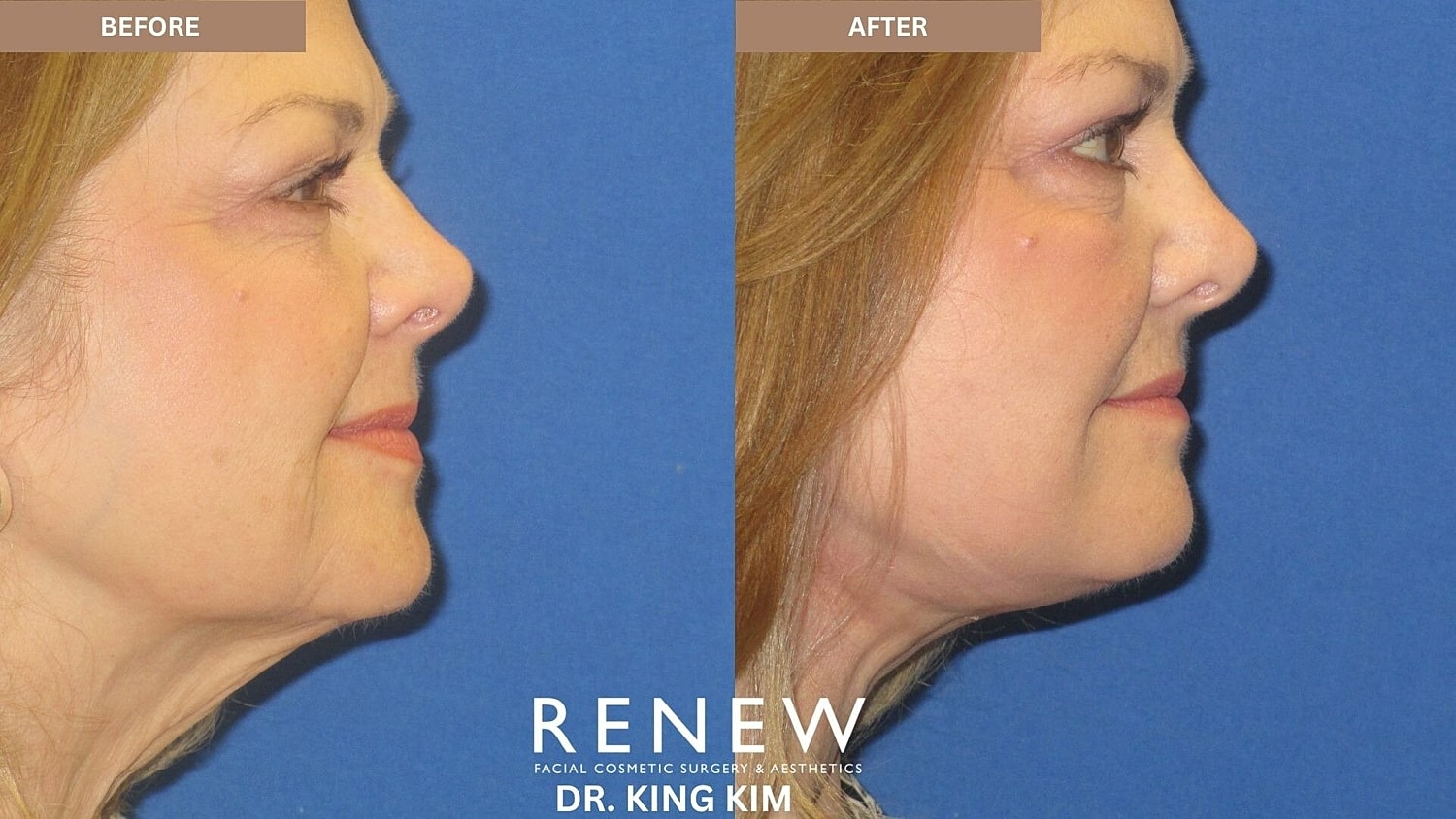 Mini Deep Plane Facelift Before & After