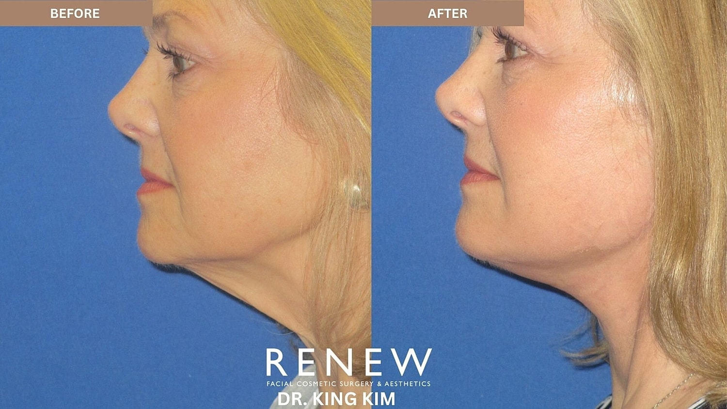 Mini Deep Plane Facelift Before & After