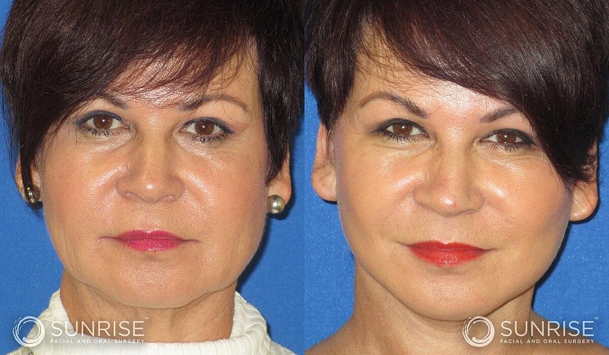 Mini Deep Plane Facelift Before & After