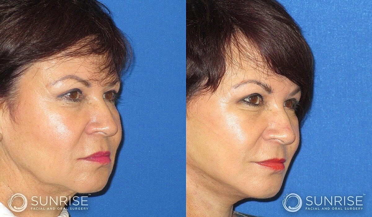 Mini Deep Plane Facelift Before & After