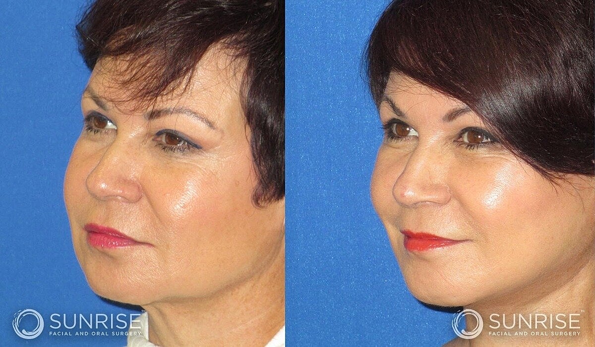 Mini Deep Plane Facelift Before & After
