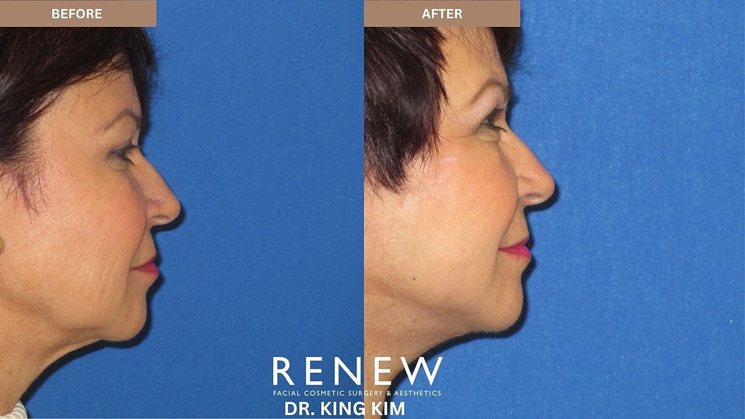 Mini Deep Plane Facelift Before & After