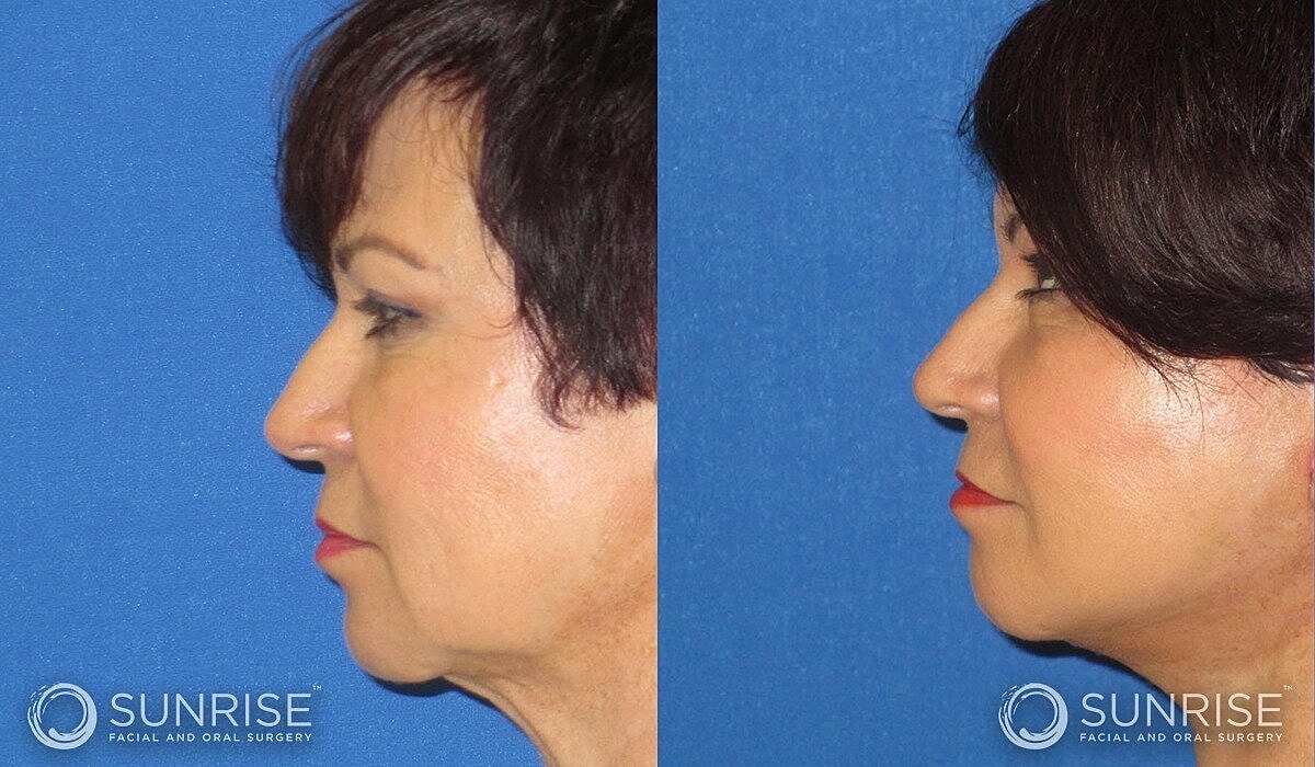 Mini Deep Plane Facelift Before & After