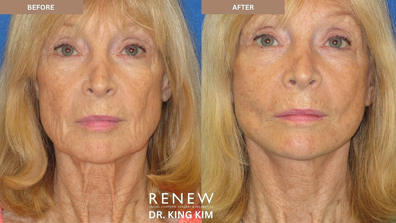 Mini Deep Plane Facelift Before & After
