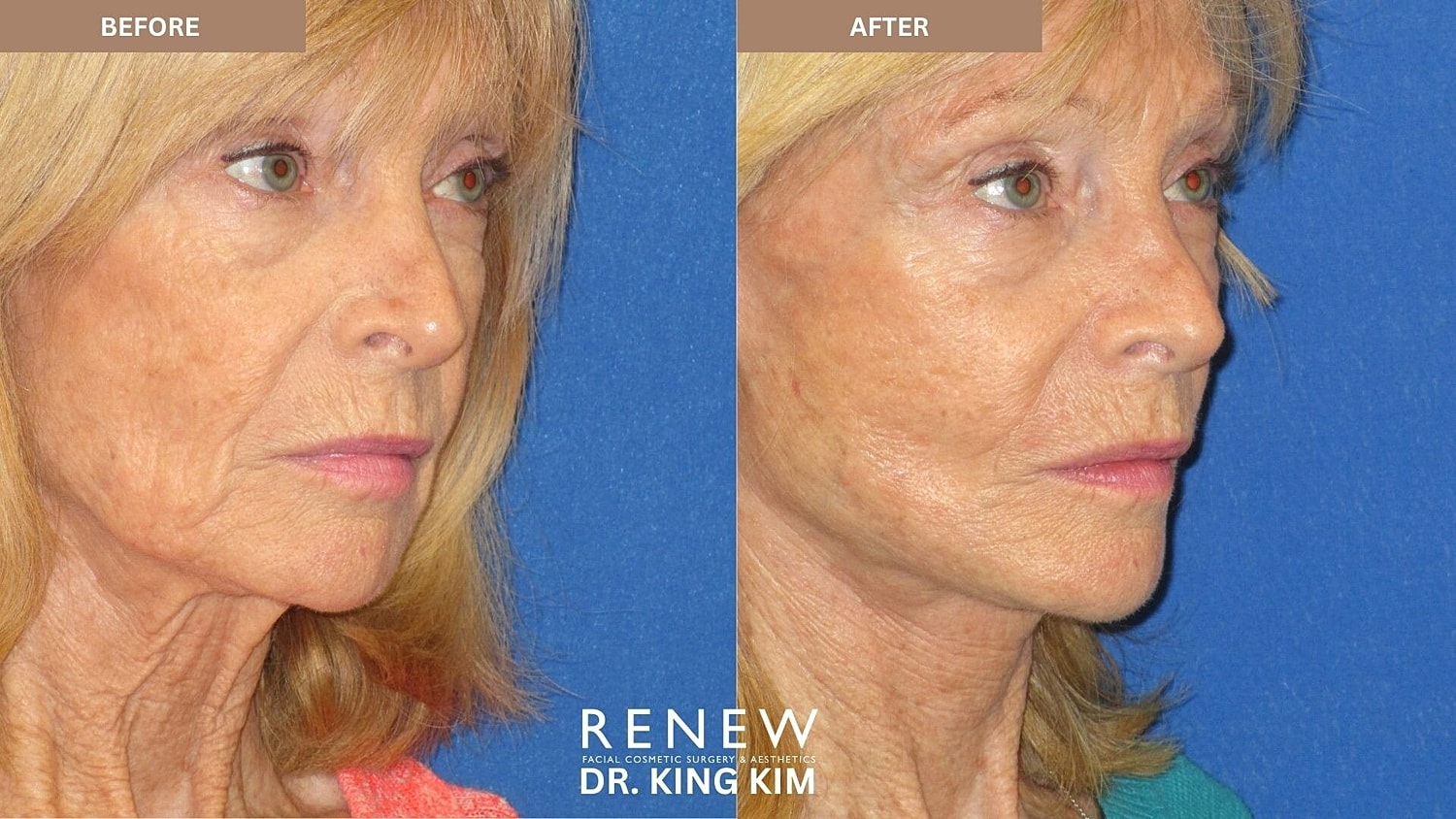 Mini Deep Plane Facelift Before & After