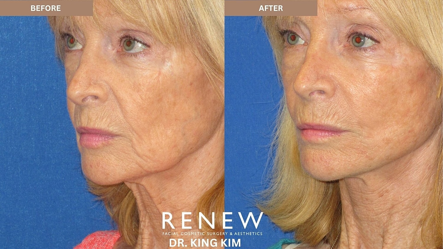 Mini Deep Plane Facelift Before & After