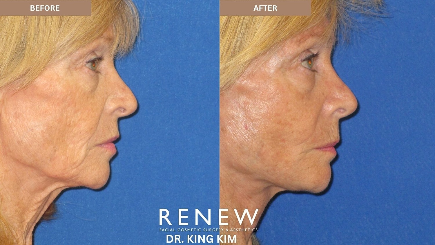 Mini Deep Plane Facelift Before & After