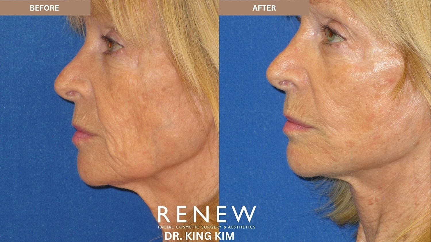 Mini Deep Plane Facelift Before & After