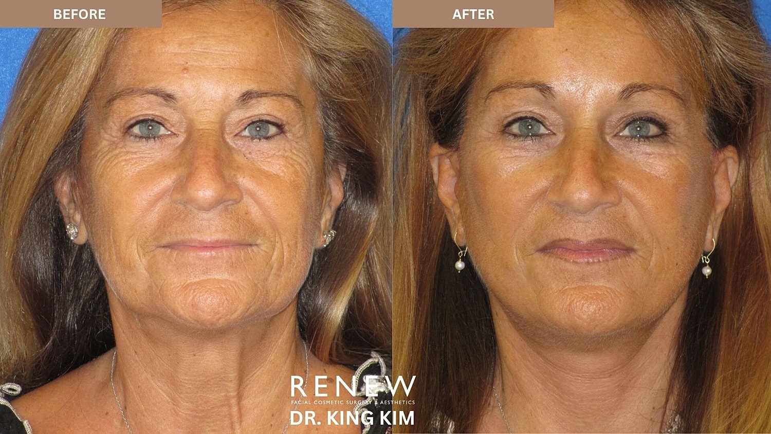 Mini Deep Plane Facelift Before & After