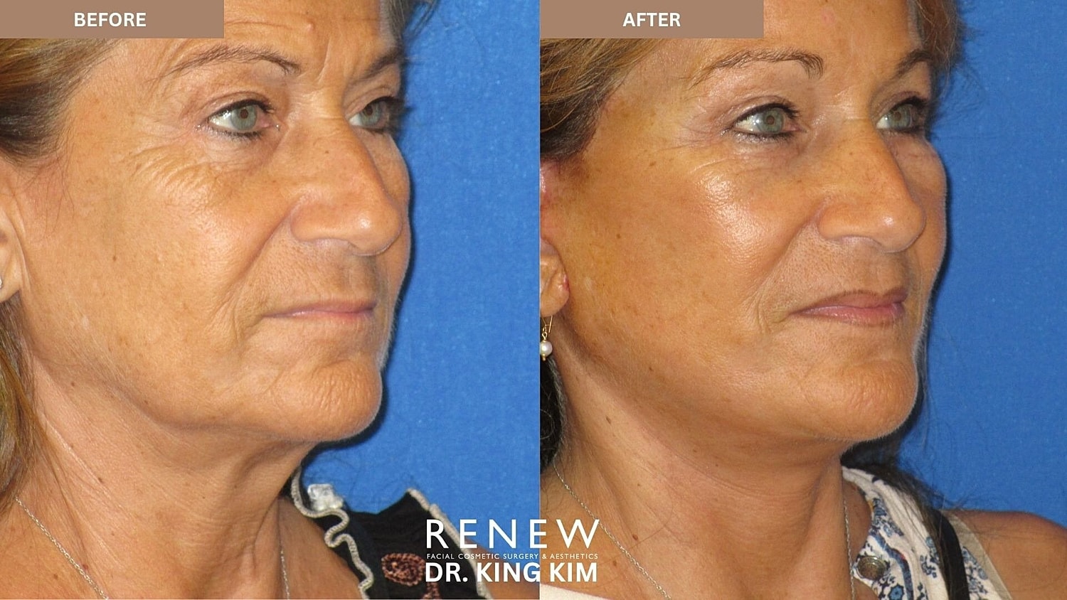 Mini Deep Plane Facelift Before & After
