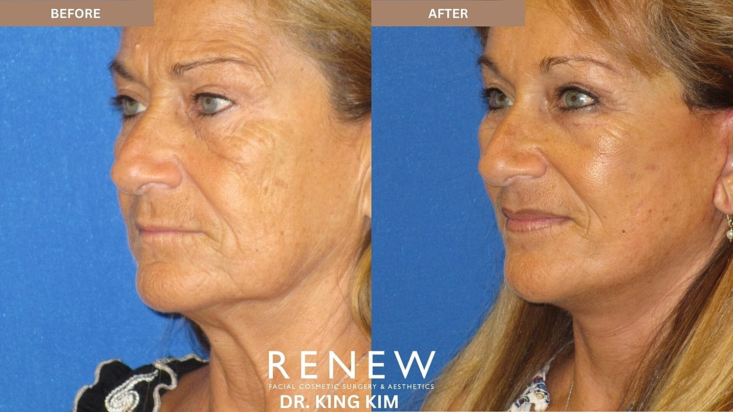 Mini Deep Plane Facelift Before & After