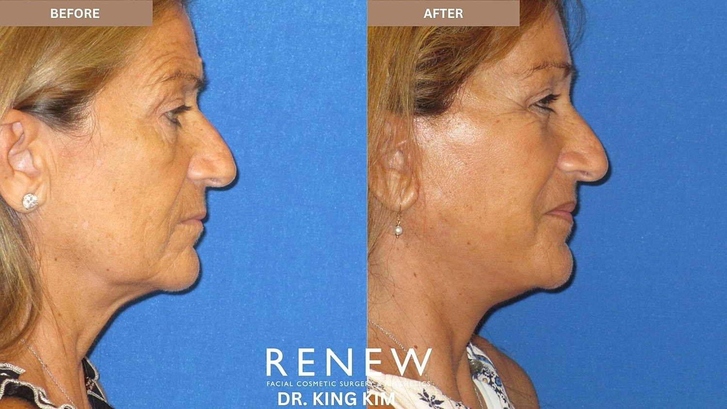 Mini Deep Plane Facelift Before & After