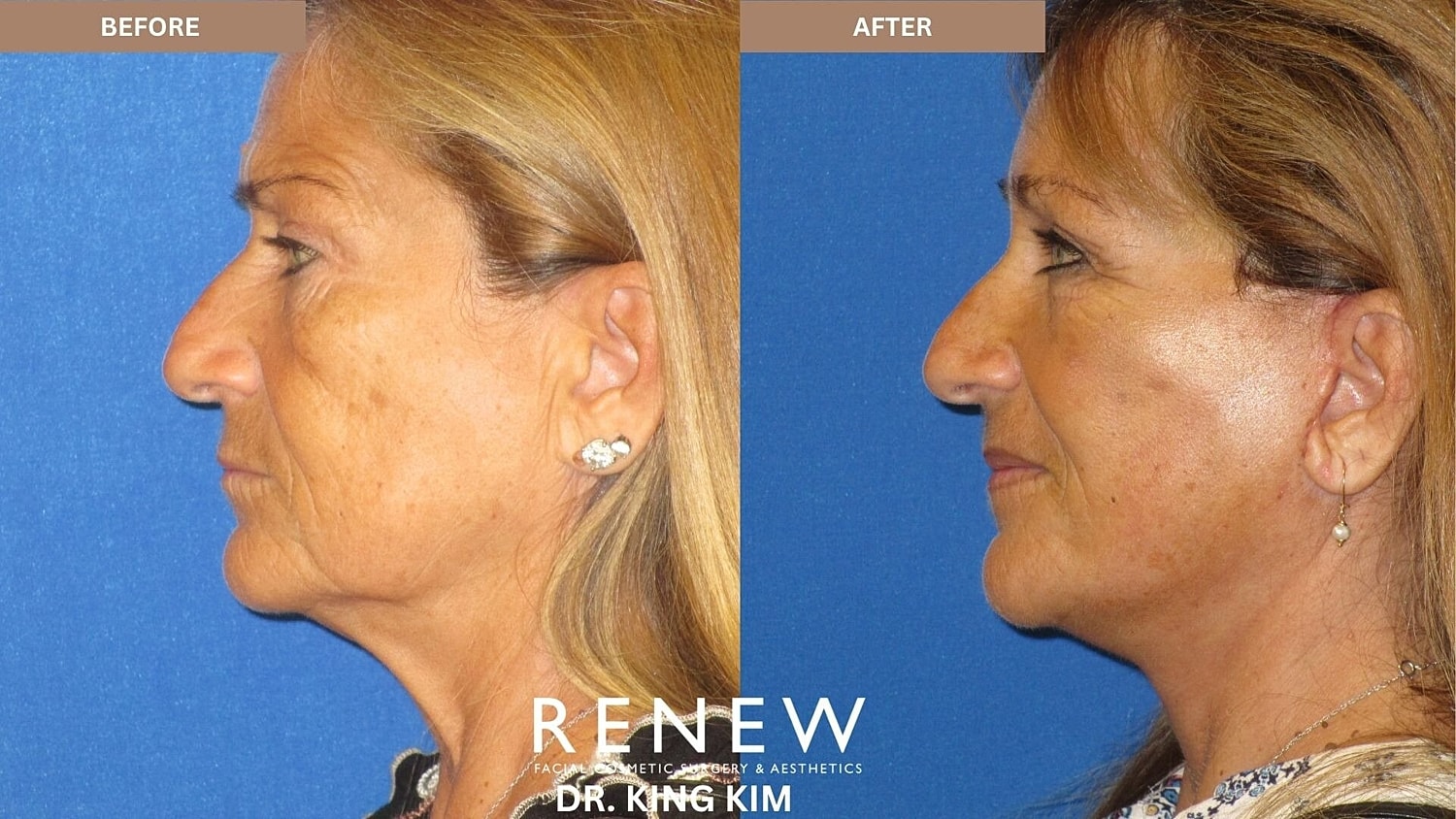 Mini Deep Plane Facelift Before & After