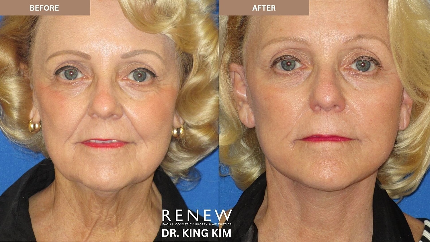 Mini Deep Plane Facelift Before & After