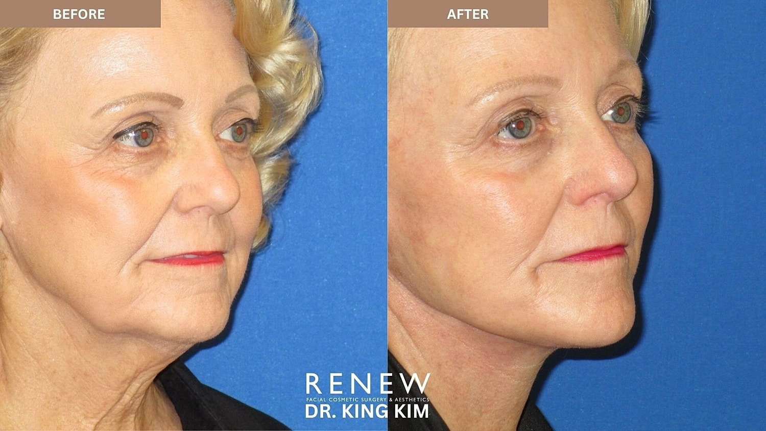 Mini Deep Plane Facelift Before & After