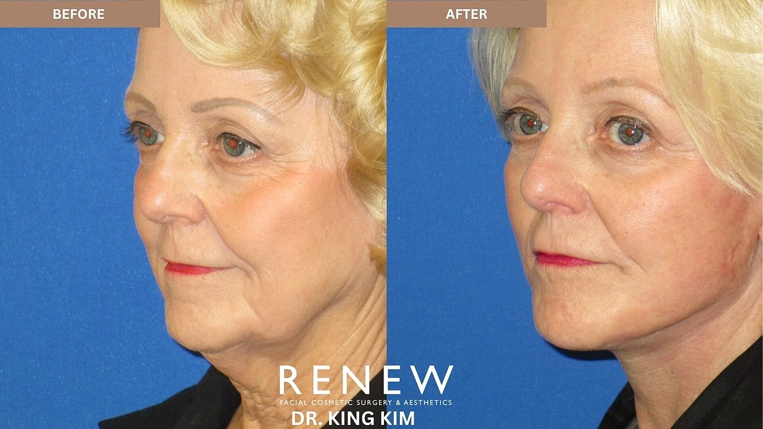 Mini Deep Plane Facelift Before & After