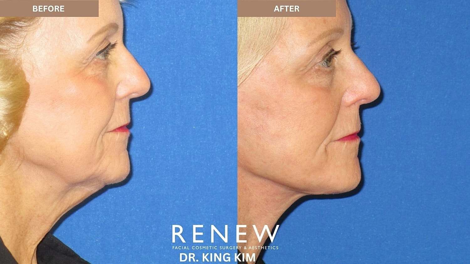 Mini Deep Plane Facelift Before & After