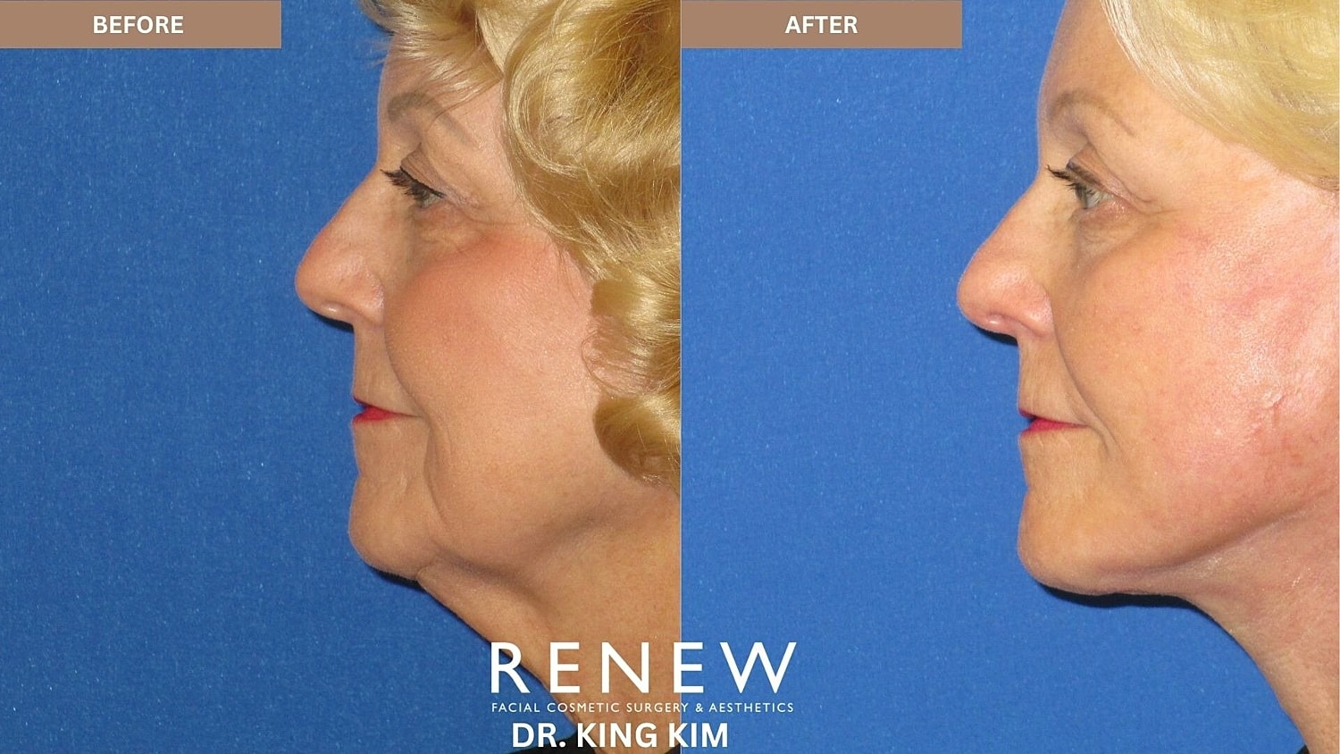 Mini Deep Plane Facelift Before & After