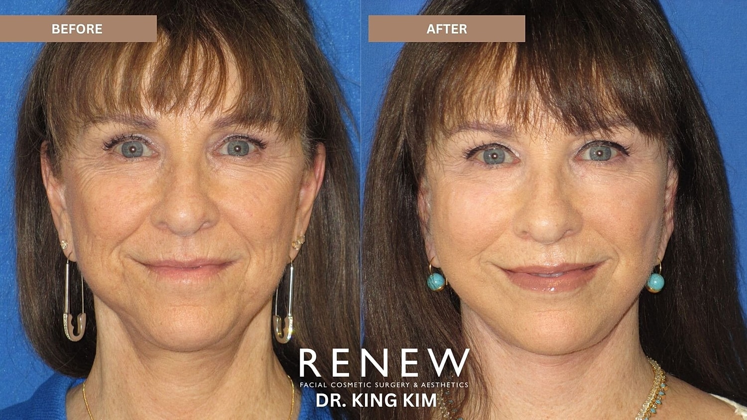Mini Deep Plane Facelift Before & After