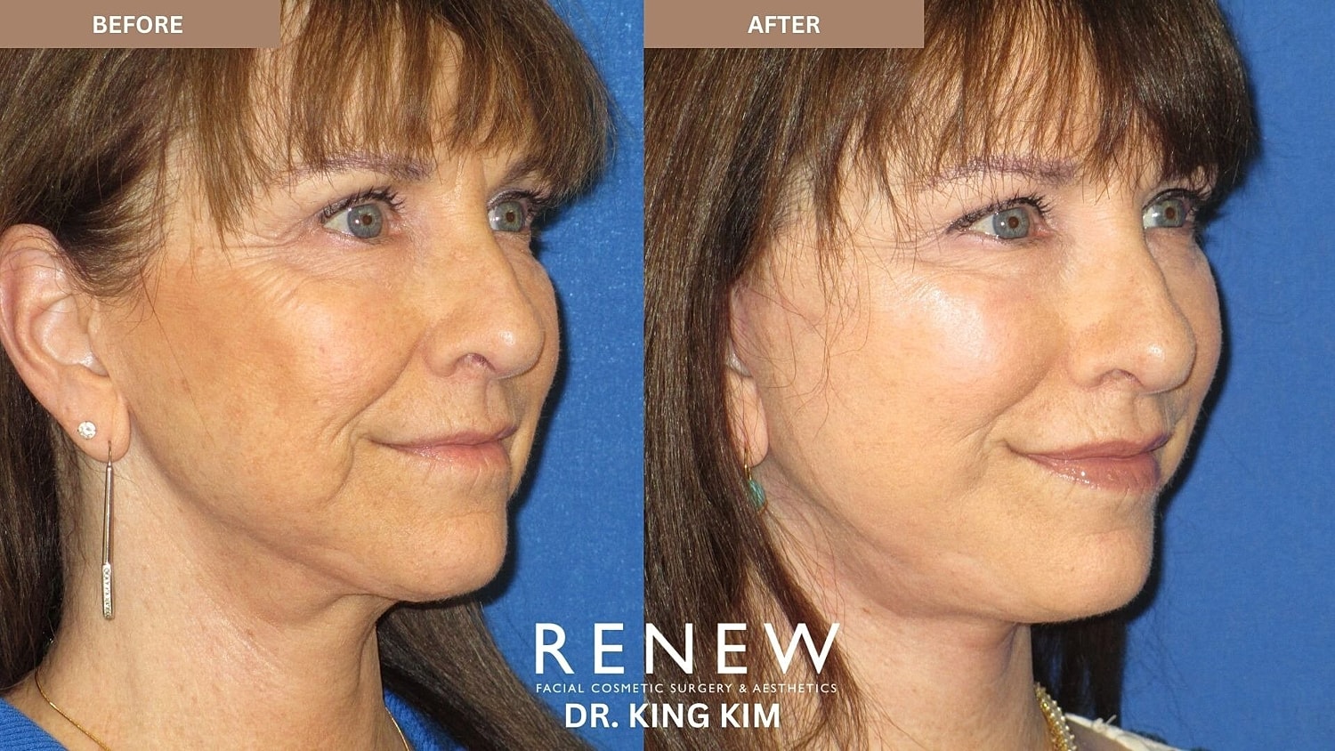 Mini Deep Plane Facelift Before & After